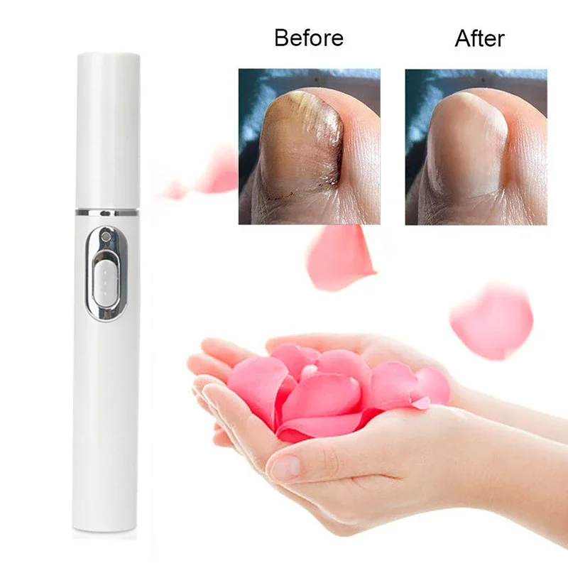 Hot Nail Fungal Pen Anti Fungus Blue Light Laser Pen Onychomycosis Painless Nail Repair Pen Nail Care Repair Serum Free Shipping