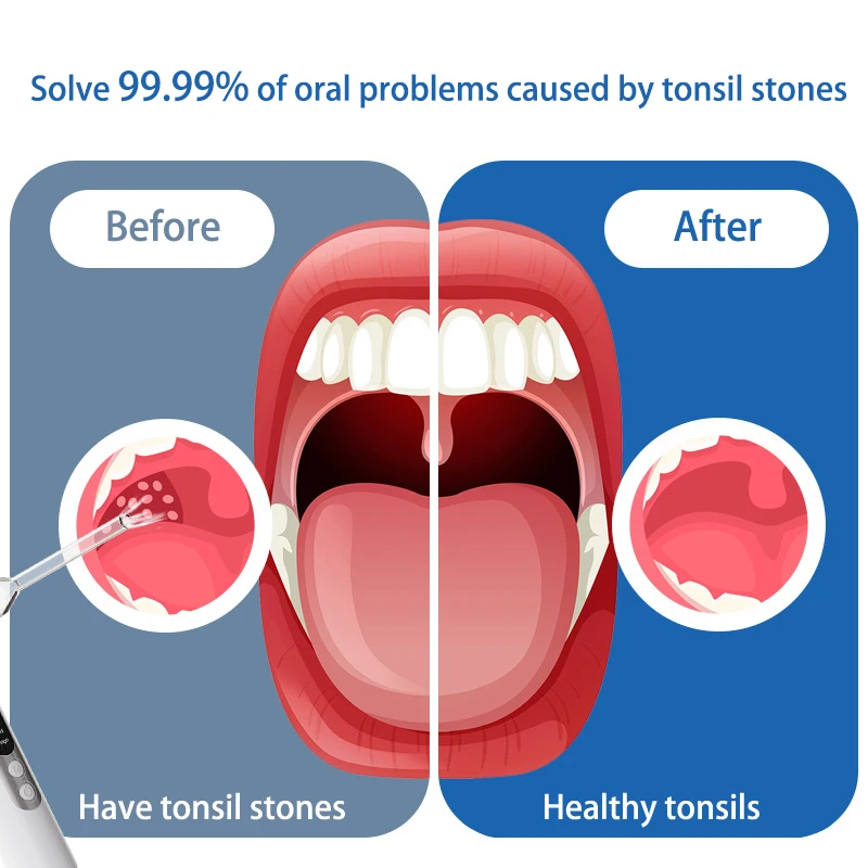 Elektryczny odkurzacz do usuwania kamieni migdałkowych Zestaw do usuwania kamieni migdałowych z strzykawką do nawadniania Natychmiastowe odsysanie