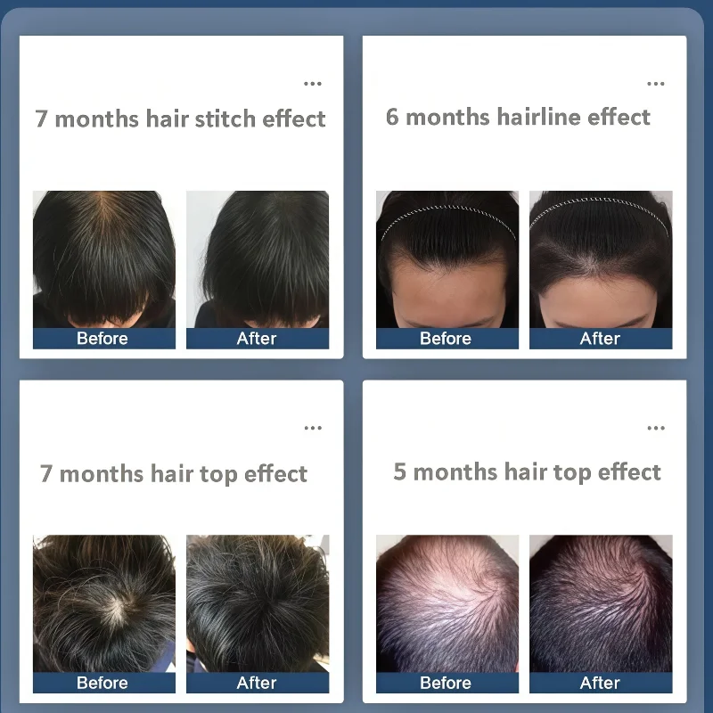 

Лазерная шапочка для волос 650 нм, 5 мВт, 96 лазеров, лечение восстановления роста LLLT для устройства для остановки выпадения волос