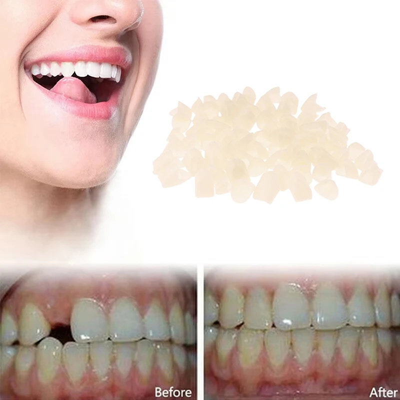 

1 Bag Dental Temporary Crown Material For Anterior/Molar Teeth Veneers Gum Protection And Stable