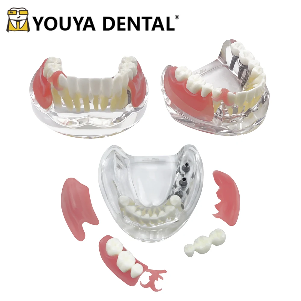 Dental Implant Model with Restoration Mandibular Implant Teaching Model for Dentist Technician Oral Medical Dentistry Equipment