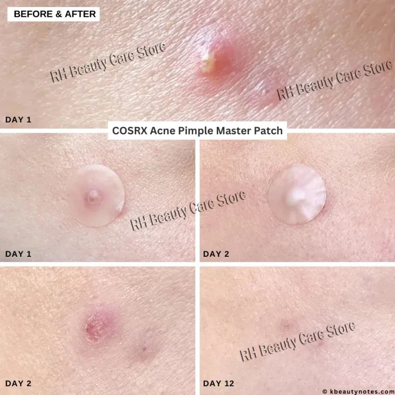 ニキビパッチ 目立たないニキビカバー 顔の油分コントロール 治療 ニキビ吸収液 透明ニキビ洗浄パッチ