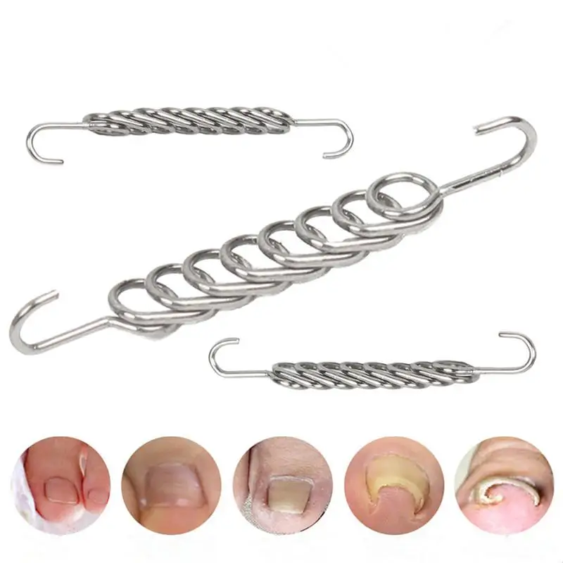 Ferramentas corretoras de unhas encravadas, pedicure, recuperação, tratamento de unhas encravadas, profissional, correção de unhas encravadas, ferramenta de cuidados com os pés