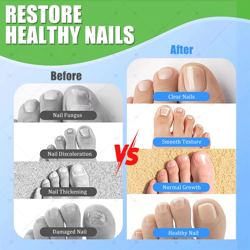 เล็บเลเซอร์สีน้ำเงิน