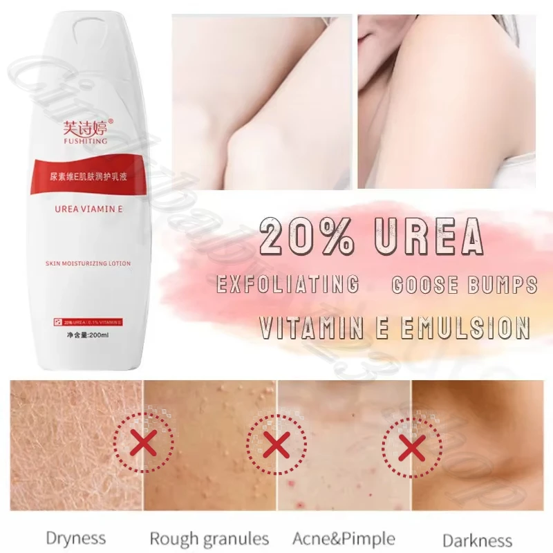 20% Urea Vitamin E Body Lotion Absorbs Effectively Improve Rough Chicken Skin Hydrating and Moisturizing 200ml