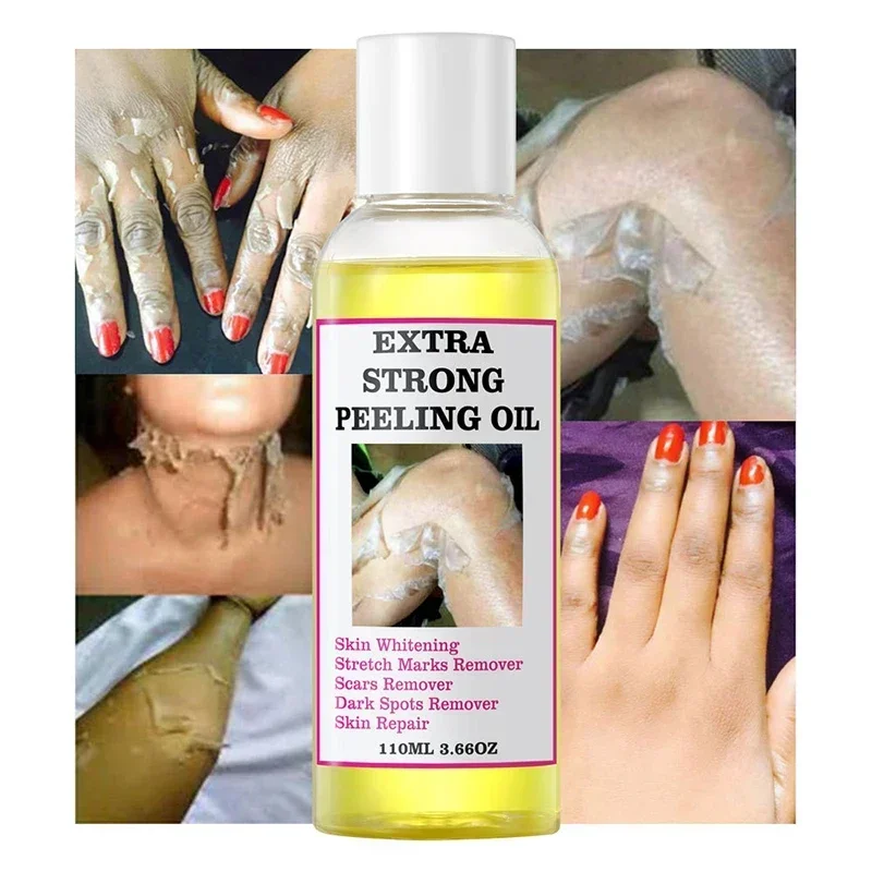 Extra Strong Yellow Peeling Oil Whitening Peeling Oil Lighten Elbows Knees Hands Melanin Even Skin Tone and Whiten Skin 110ml