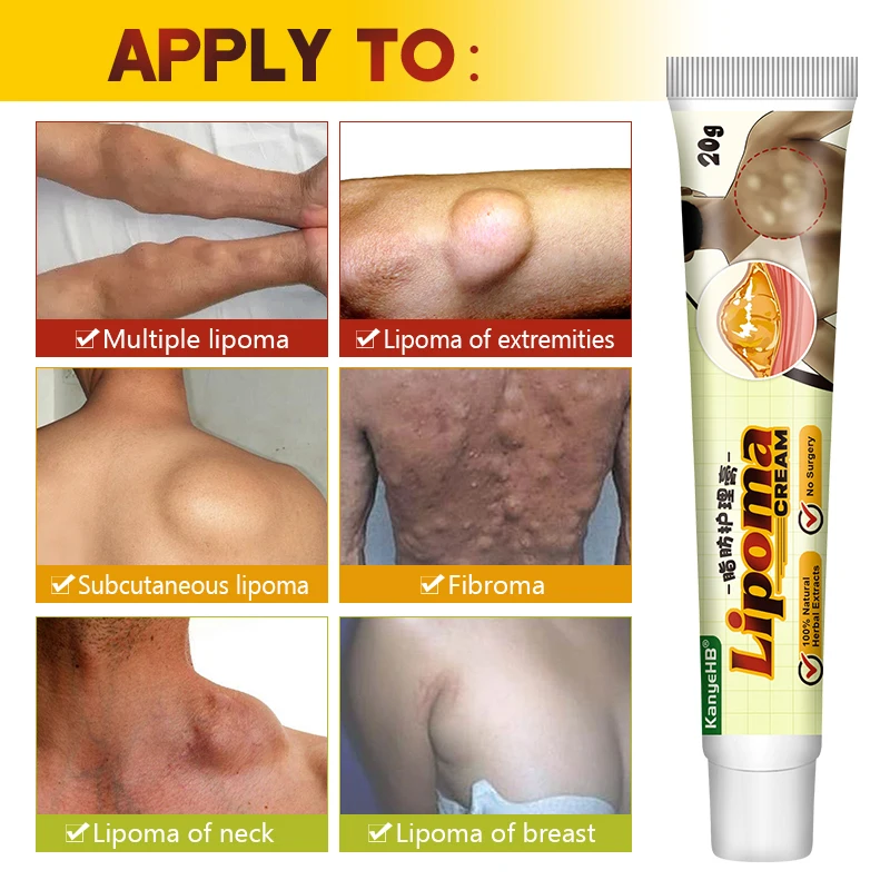 1Pcs Lipoma Removal Cream Removes Lipoma Fibroids Herbal Skin Swelling Cellulite Ointment Tumor Exfoliating Health Care G040