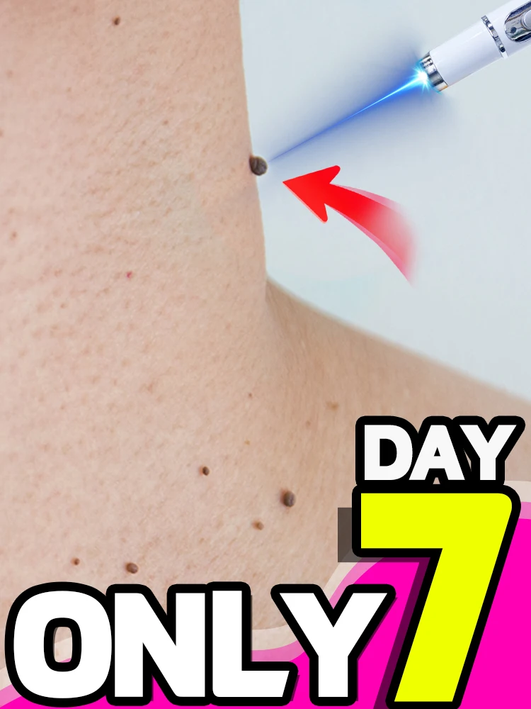 إزالة الثآليل الضوئية، استعادة البشرة الناعمة، إزالة الثآليل الدقيقة، فعالة وخالية من القلق #1