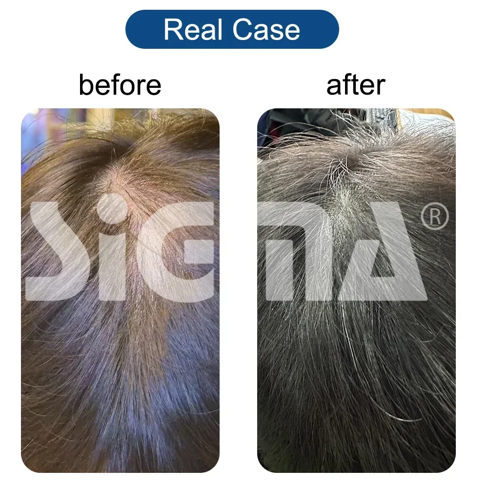 

IN STOCK Hair Loss Treatment AGA Light Therapy 650nm Only Hair Regrowth Cap Red Light Therapy Helmet