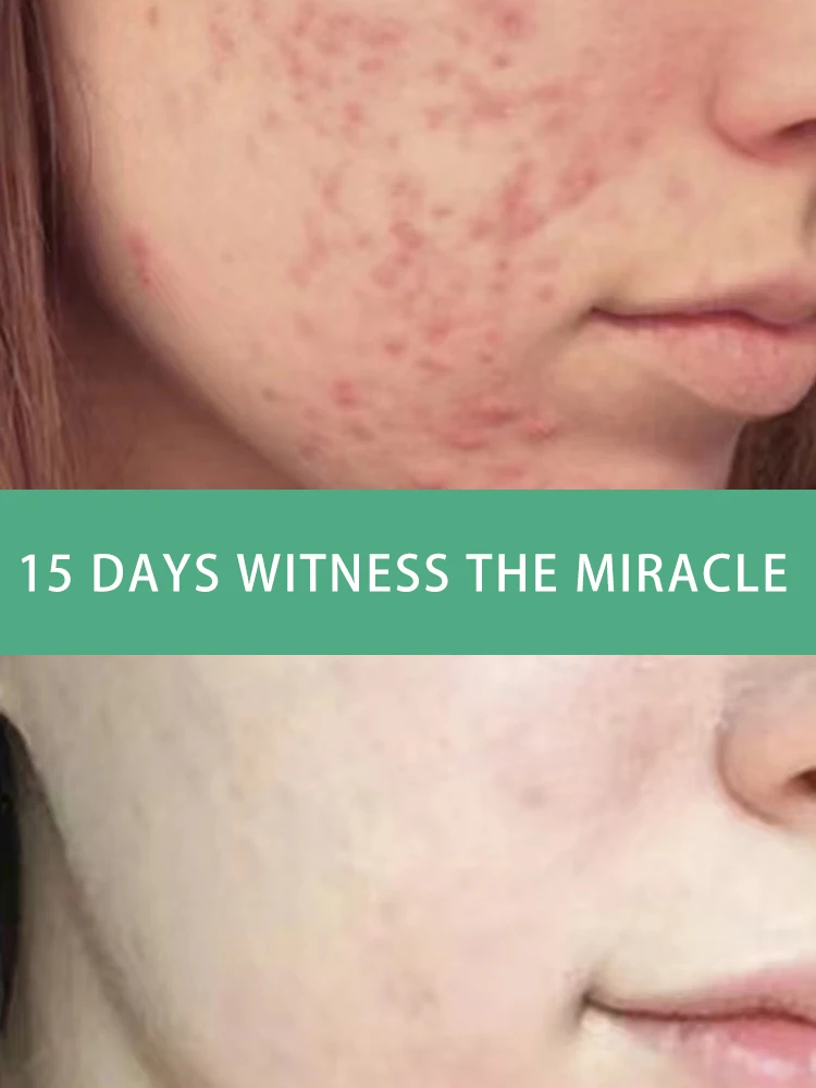 

Herbal Acne Treatment Cream Face Scar Blackhead Remover Repair Gel Oil Control Shrink Pores Whitening Skin Care