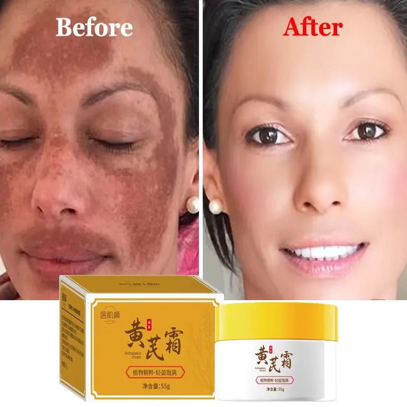 Astragalus Whitening Freckle Cream Remove Dark Spots Anti Freckle Niacinamide Fade Pigmentation Melasma Brighten Skin Care 55g