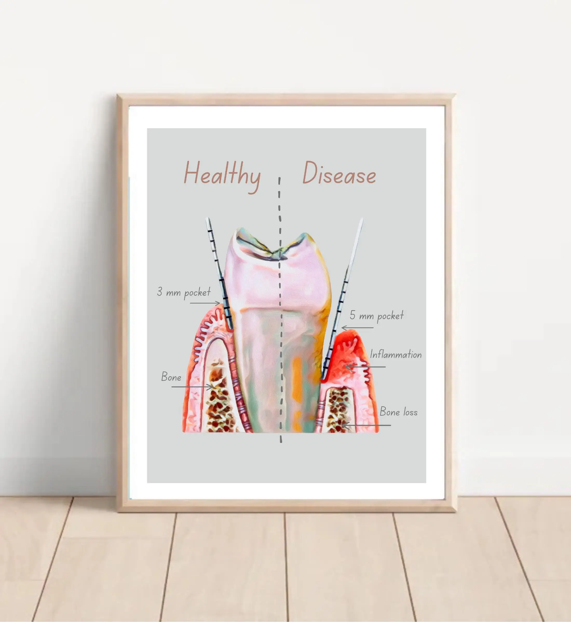 Patient Education Dental Cavity Prevention Oral Health Dental XRay Tooth Anatomy Periodontal Disease Dentist Art Canvas Print