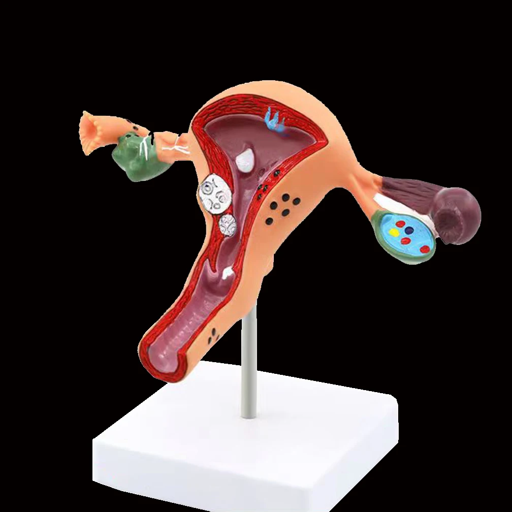 Female Pathological Uterus Ovary Model Anatomical Disease Pathology Lesion For Biology Teaching Human Medical Props Models New