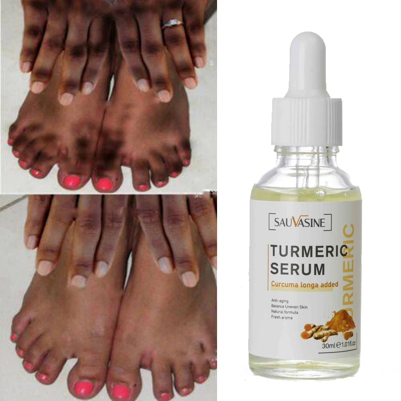 Turmeric Lemon Oil Skin Glow To Lightening Acne Dark Patches, Acne   Bright Skin Dark Spot Corrector Face Whitening Serum