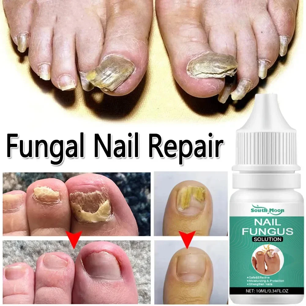 Fungal Nail Treatment Essence Oil Nail Fungus Laser Device Repair Toenail Fingernail Ginger Treatment Hand Foot Essence Liquid