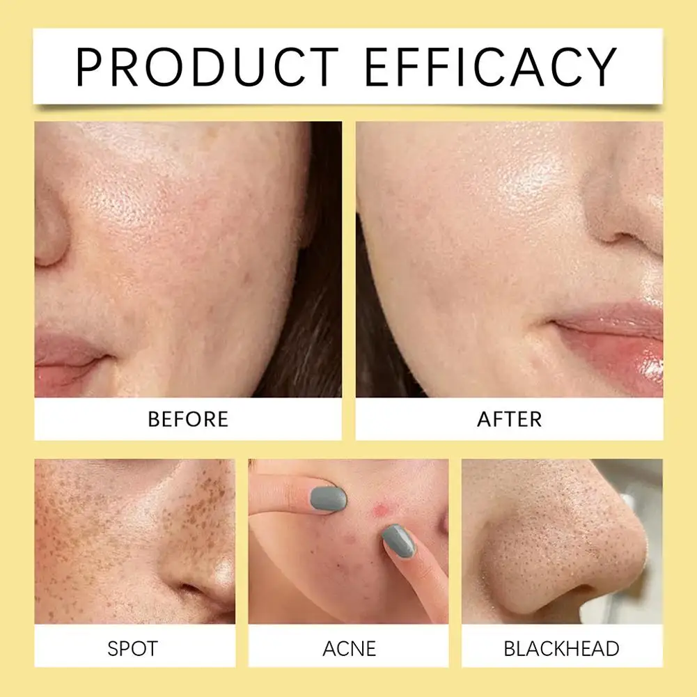 وسادة العناية بالوجه المركزة بفيتامين النياسيناميد تقلل من المسام ومضادات الأكسدة ويقلل البقع السوداء والتحكم في الزيت 70 قرصًا #3