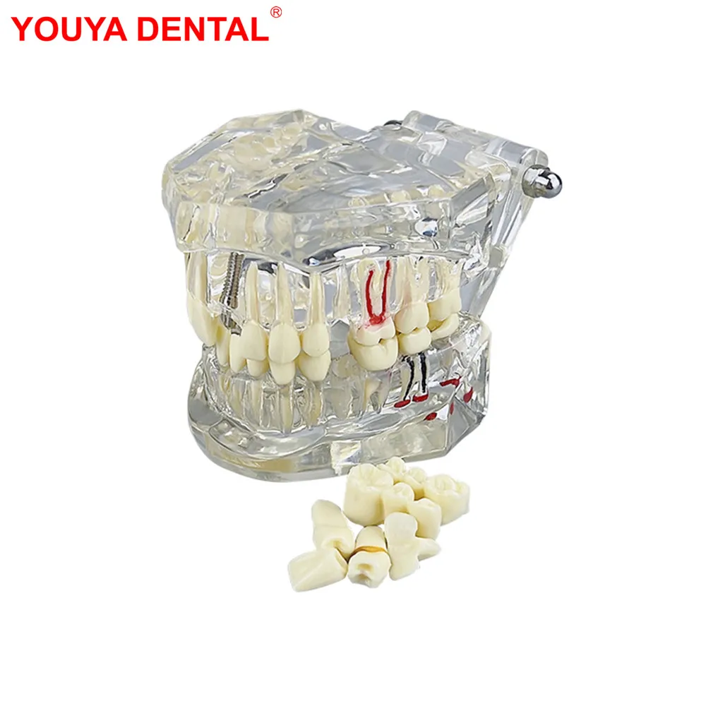 Removable Teeth Model Implant Disease Dentist Studying New Dental Model Teeth Implant Restoration Bridge  Teaching Demonstration