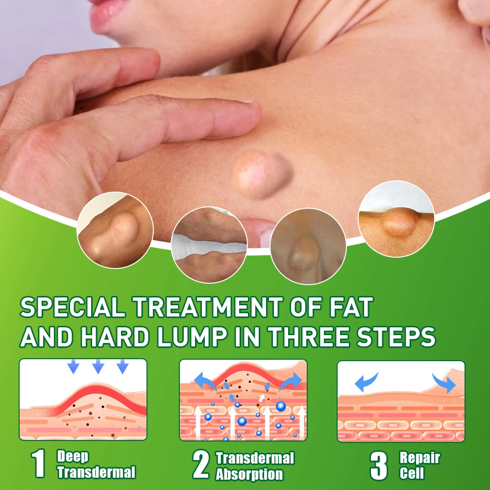 10 г, Sumifun Lipoma, средство для удаления грязи, подкожный крем для устранения отеков и жира