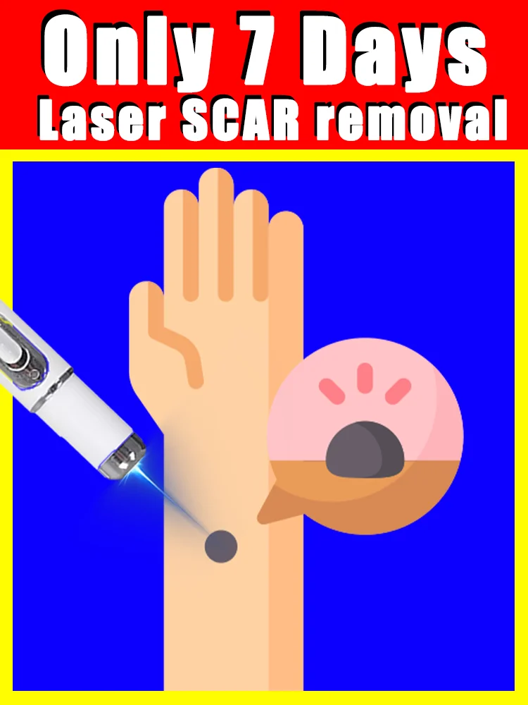 blue light pen solve warts,feet,shoulders,neck,head,hands,free shipping,wart care tools