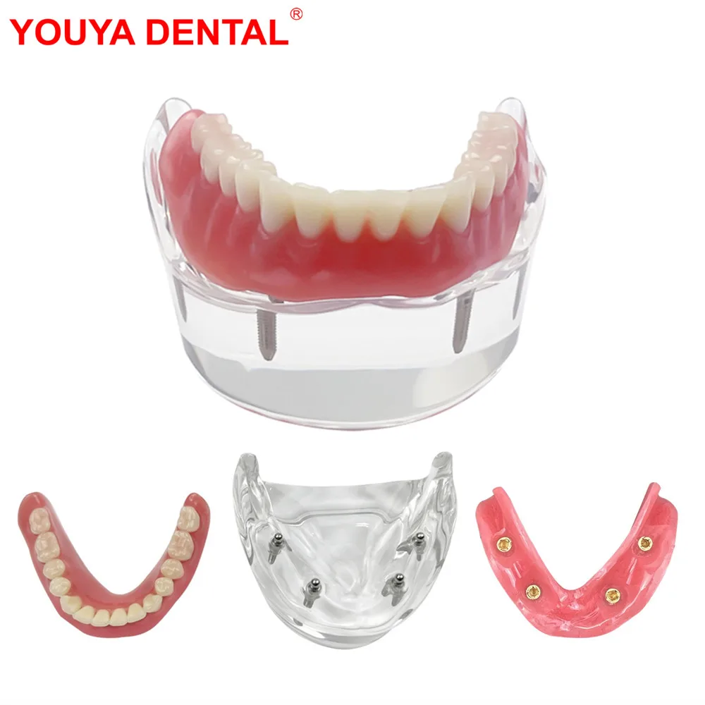 Lower Dental Implant Teeth Model Transparent Dental Model Teeth Implant Restoration Bridge Removable For Education Teaching Demo