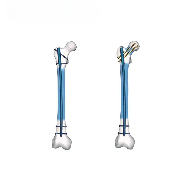 Femoral Reconstruction Intramedullary Interlocking Nail with Orthpaedic Instruments [Materials & Accessories]