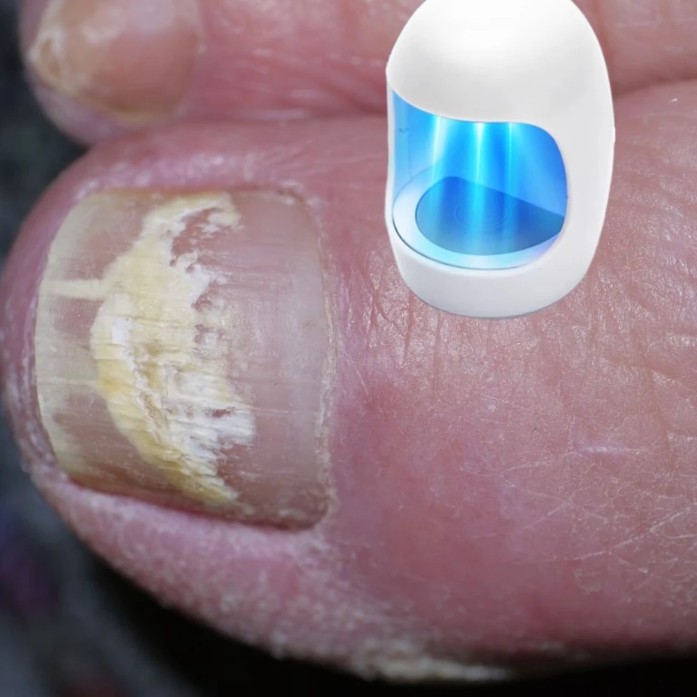 

Лазерное устройство для лечения онихомикоза для ремонта ногтей на ногах и ногтей, лечение грибка, инструмент для лечения ногтей