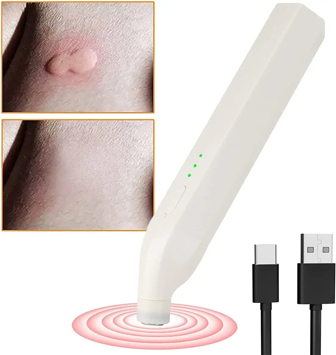 Mosquito Bite Heat Pen, 2023 Mini Insect Bite Healer, Electric, Pure Physical Mosquito Bite Burner, Heat Pen Against Mosquito Bi