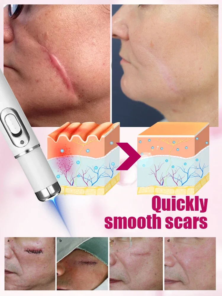 Safe and scar-free