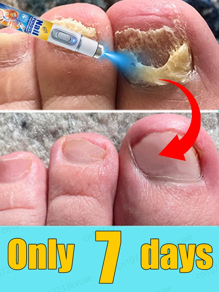 

Say goodbye to onychomycosis and restore normal nails