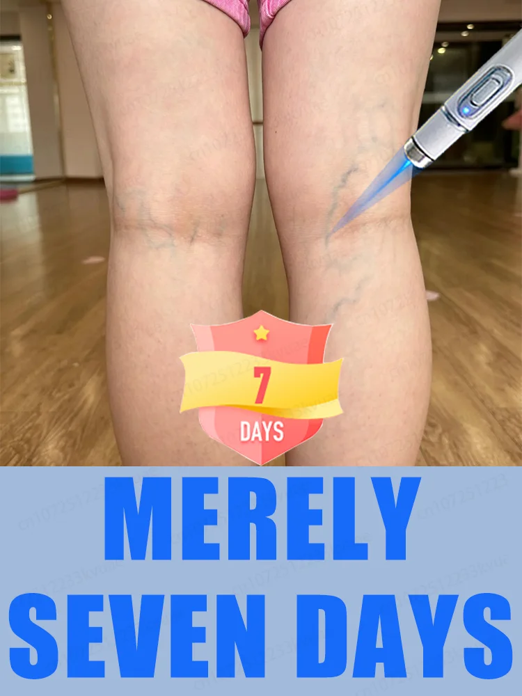 

2nd generation laser venous treatment pen, used to treat varicose veins