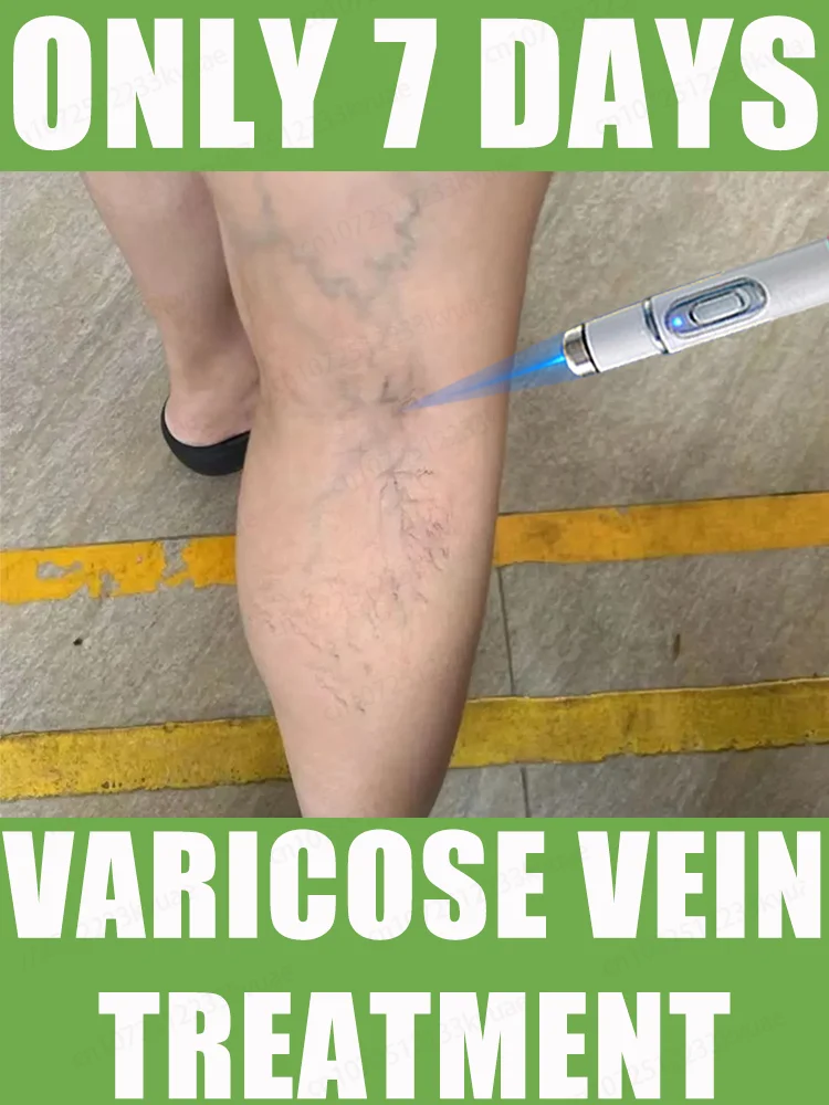 

blue light pen solve varicose veins, hot sale leg care tools