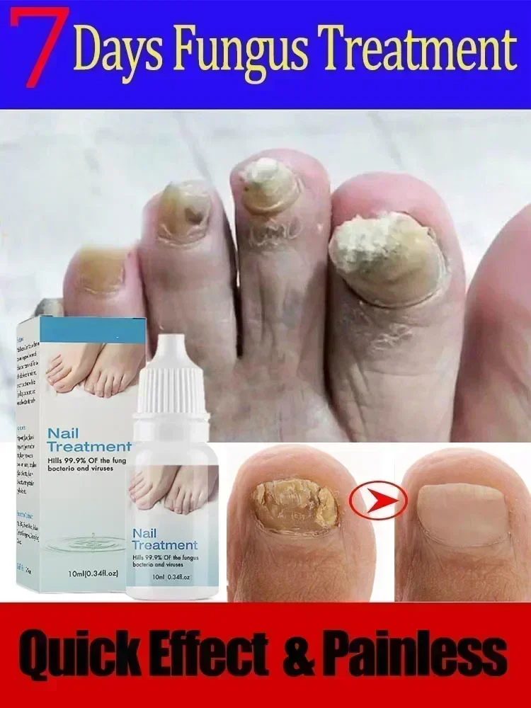 Soro do fungo do prego, líquido do reparo do pé, Toe Nail Fungus Remoção Gel, Anti infecção, Paronychia, Onicomicose