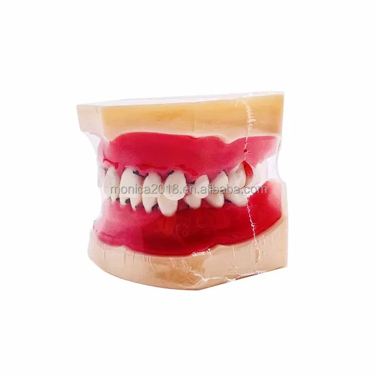 den tal Periodontal Disease Model Teeth Anatomical Pathology Model Tooth den tal Human den tal Care Model