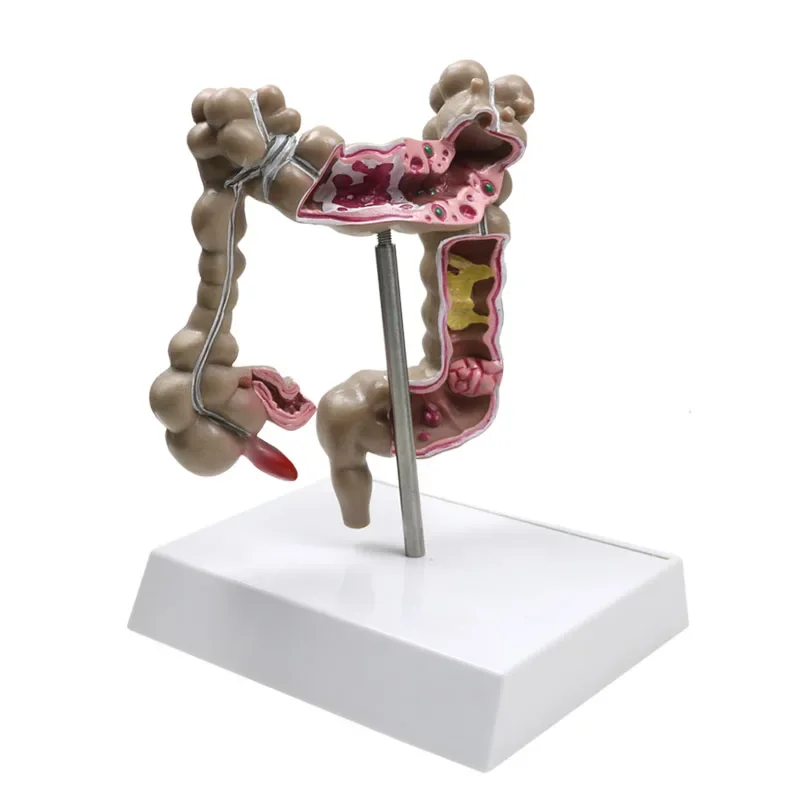 GREATLH Pathological Diseases Model Human Colorectal Lesion Model Teaching Learning Tool