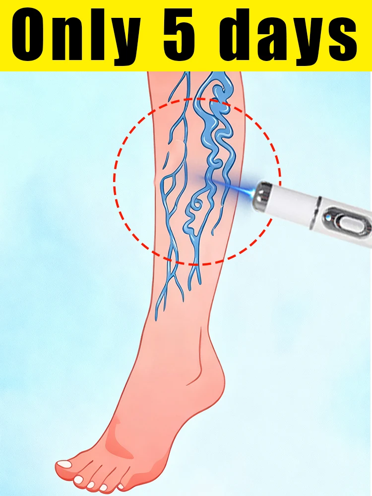 

Say goodbye to "little earthworms" on your legs: Enhanced vein care