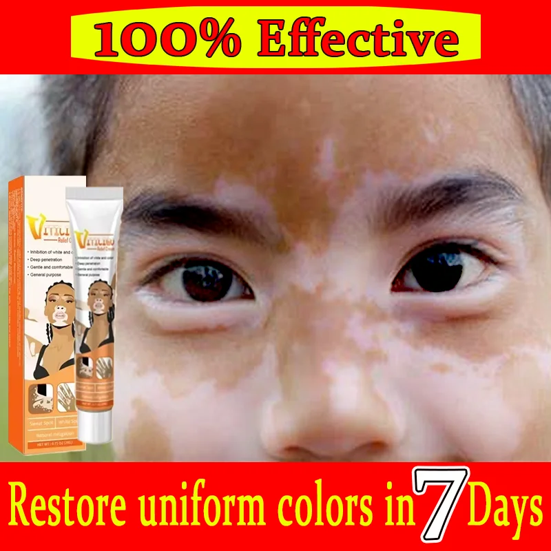 Vitiligo treatment  Vitiligo derma relief Skin treatment soothing White Spot Removal vitiligo ointment Eliminate pigment