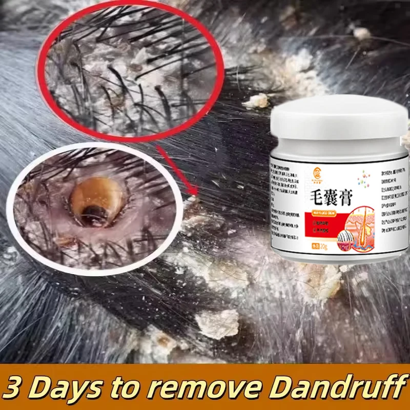 

Скраб для лечения кожи головы, удаление перхоти, зуд, контроль масла, защита от выпадения кожи головы, ремонт, красота, средства по уходу за волосами