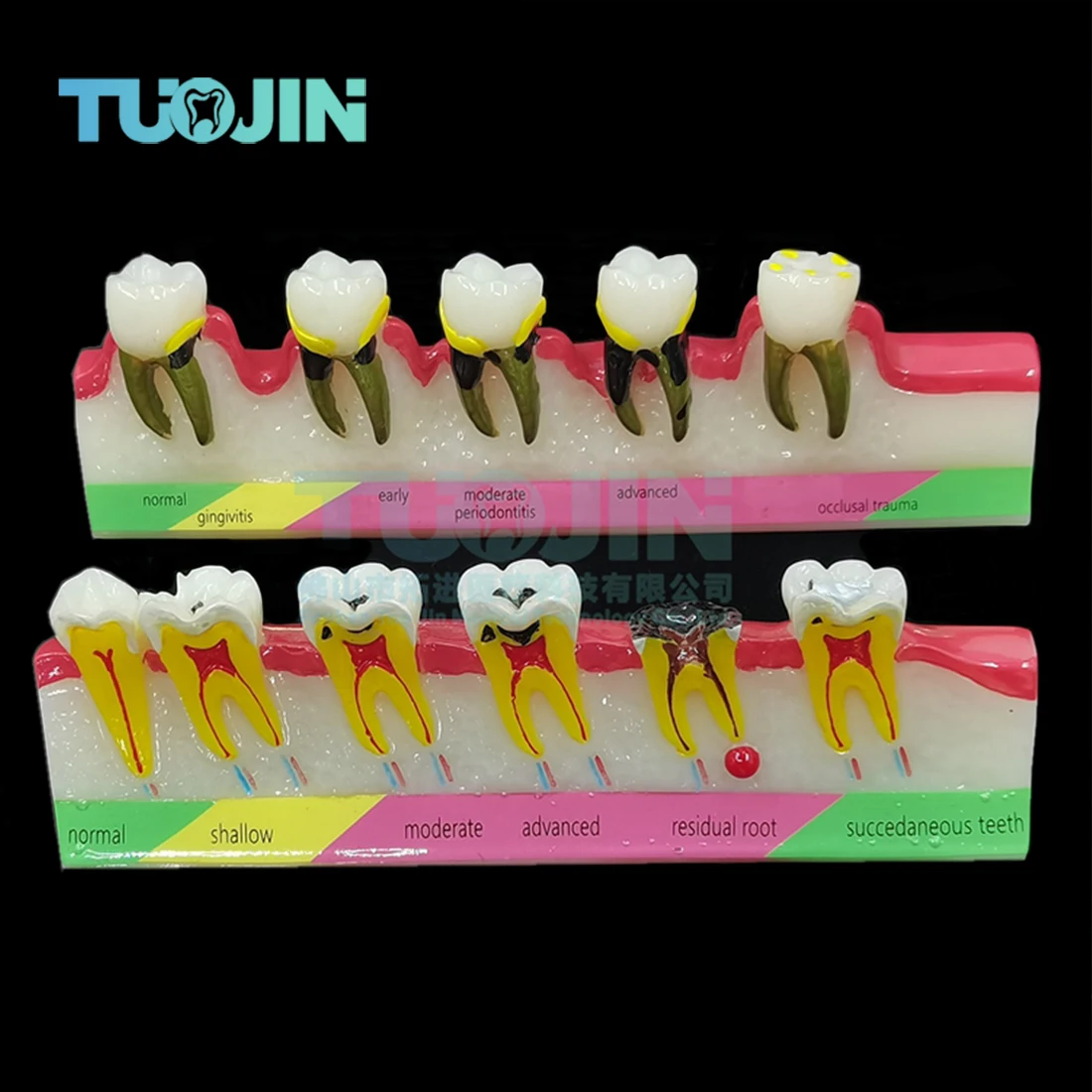 Dental Model Disease Tooth Model Tooth Dental Teaching Model for Dentist Teaching Training Learning Doctor-patient Communication