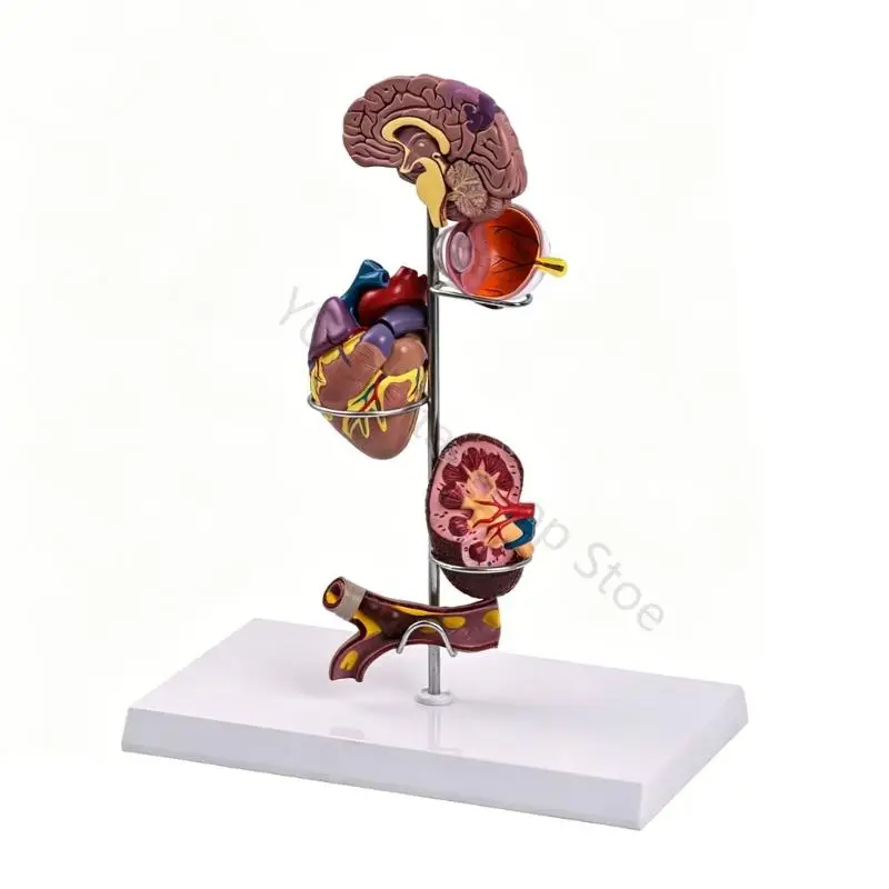 96BA Detailed Diabetes Hypertension Anatomical Model For Medicals Education And Training