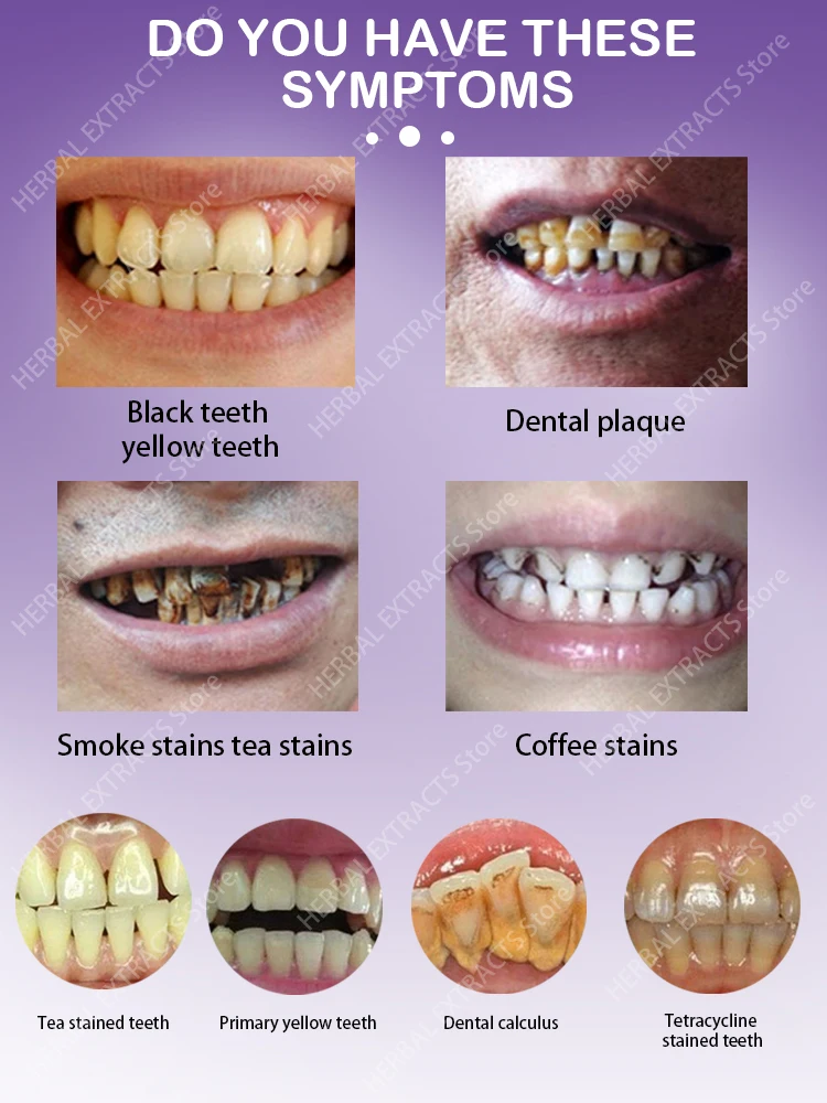 Prodotti per i denti schiuma sbiancante placca dentale calcolo