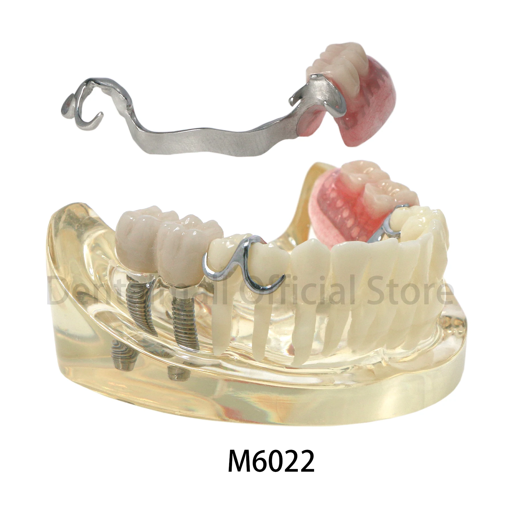 Dental Teeth Model Typodont Restoration Model Steel Bracket Model with Partial Denture Demo 2 Implants