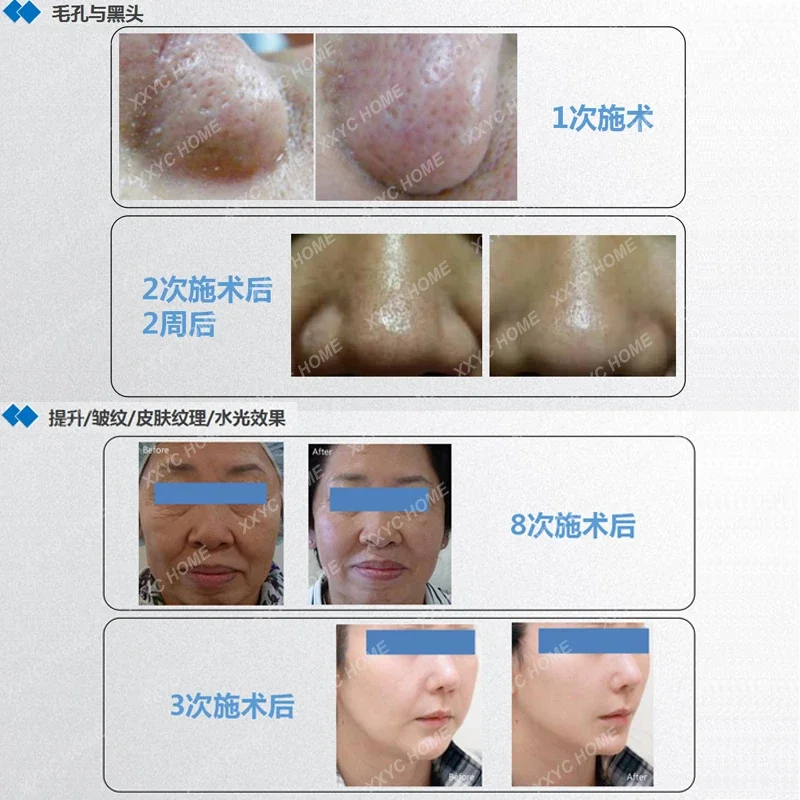 Exosome Cell Planting Instrument Face Introduction Beauty Instrument Non-invasive shallow water guide light hydration