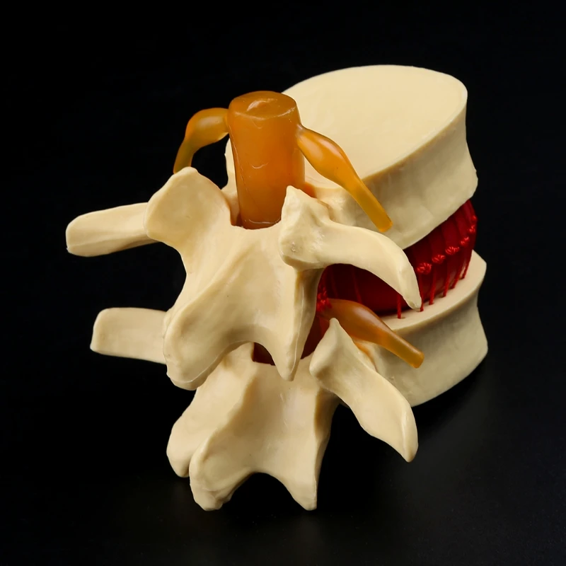 Modelo de enseñanza de hernia Lumbar, Anatomía Humana, esqueleto, columna vertebral, vértebra, modelo de demostración de Patología