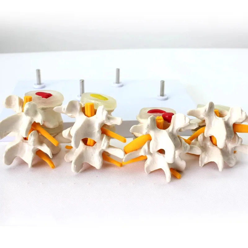 4-stage Pathological Human Lumbar Spine Anatomy Model Medical Science Teaching Tool