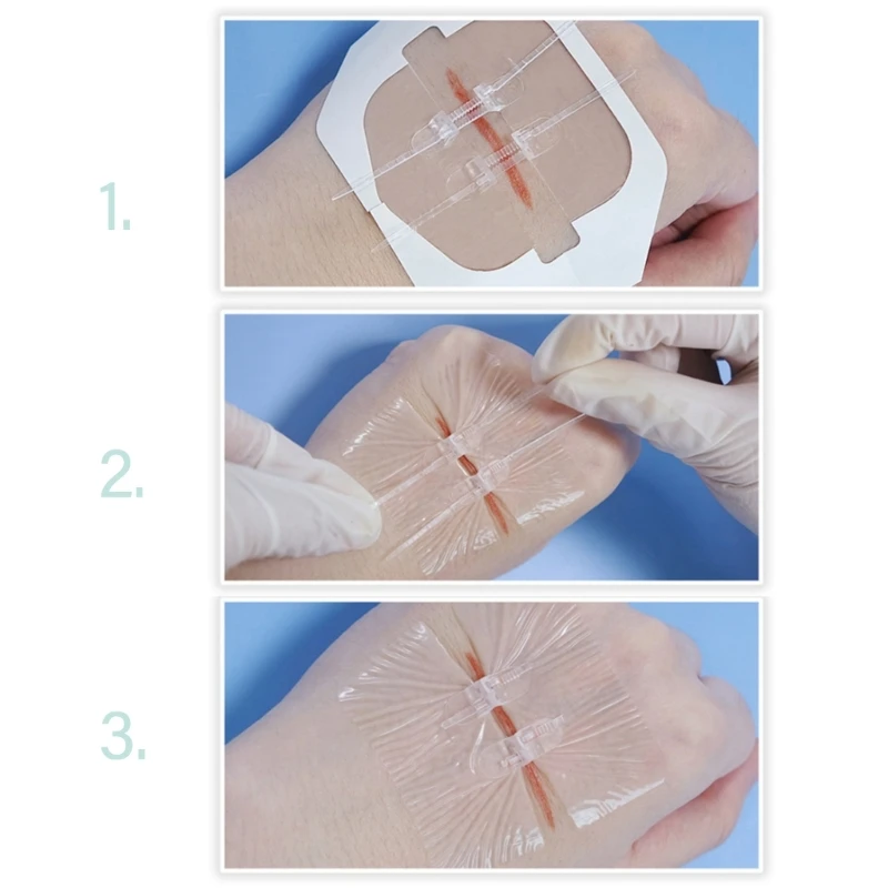 Painless Zipper Stitches Emergencies Wound Closures Device Stitches Sutures, Butterfly Zipstitch Laceration