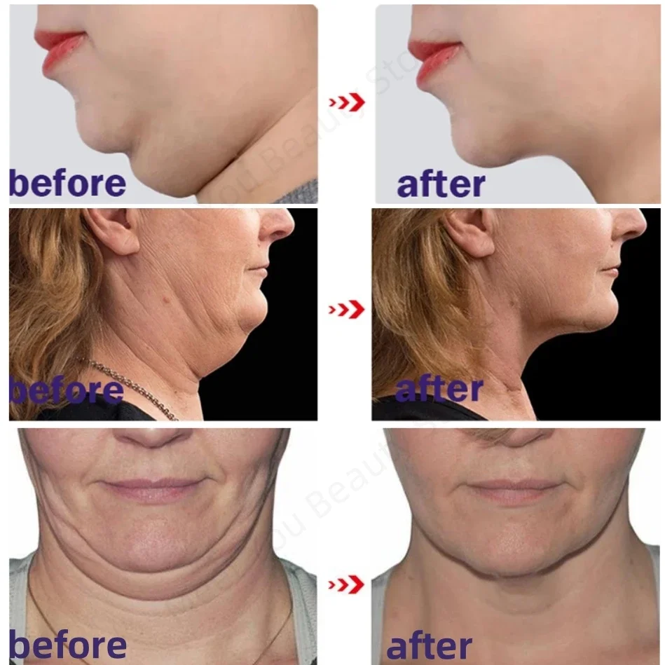 V-Shape Slimming Cream Firm Face-lift Removal Double Chin Eliminate Masseter Muscle Tighten Two-Mandibular Line Anti-aging Cream