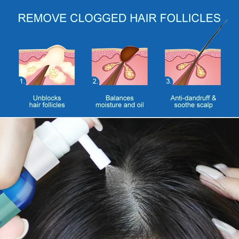 5PCS Hair Dandruff Scalp Treatment Essence Spray Beauty Health Prevent Itch Oil Control Anti Hair Loss Hair Serum Product PURC