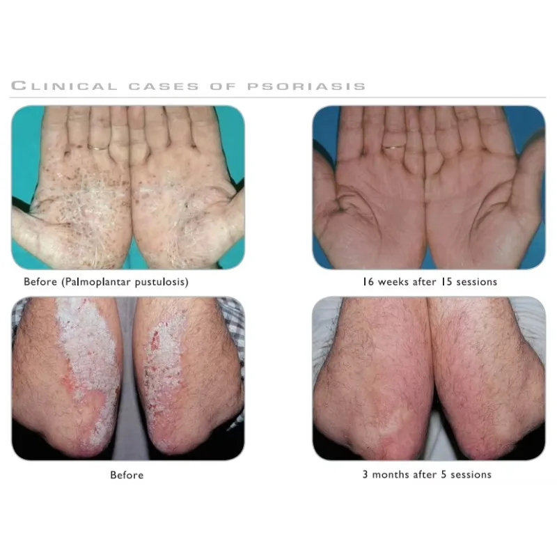 Excimer Kernel Excimer 308nm Vitiligo UVB Lamp Phototherapy Uv Ultraviolet Phototherapy Eximer Laser Vitiligo