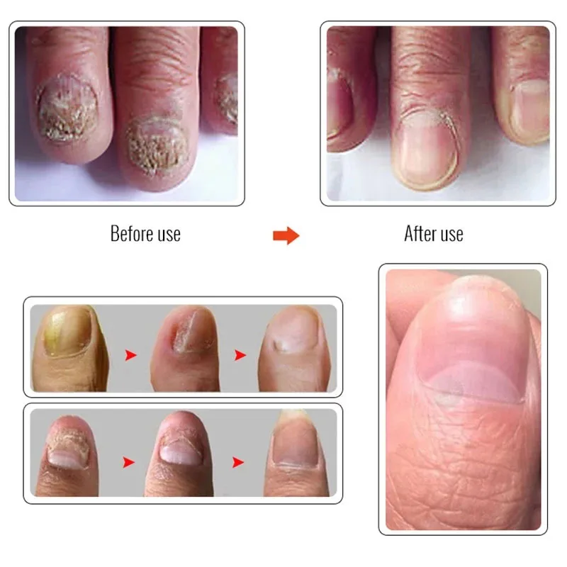 7 Days Nail Fungus Treatment Essence Toe Nails Fungal Removal Essential Oil Anti Infection Paronychia Onychomycosis Nail Care