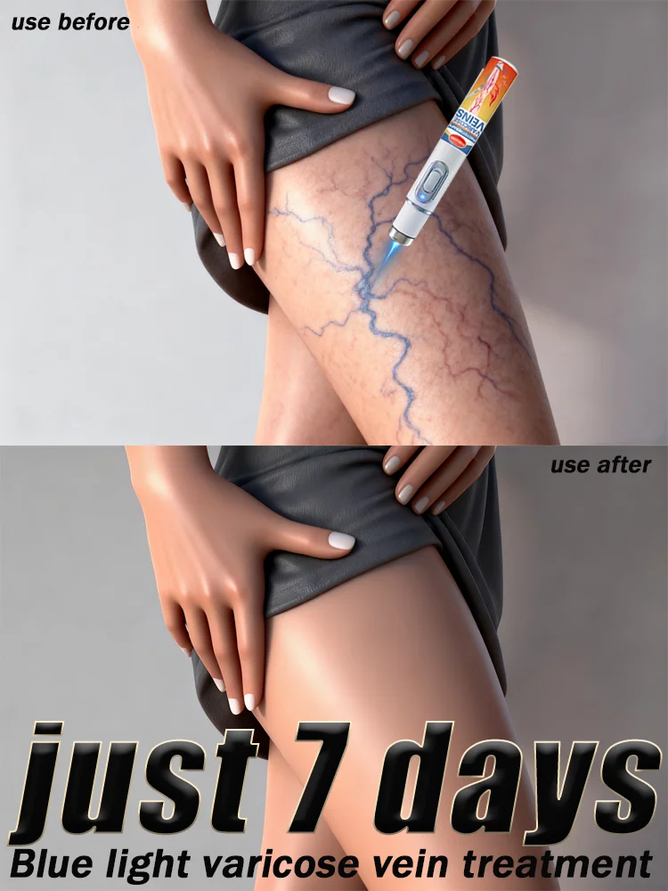 

Vᴀʀɪᴄᴏsᴇ ᴠᴇɪɴ ʙʟᴜᴇ ʟɪɢʜᴛ . sᴀʏ ɢᴏᴏᴅʙʏᴇ ᴛᴏ sᴘɪᴅᴇʀ ᴠᴇɪɴs ᴀɴᴅ ʟᴇɢ ᴘᴀɪɴ ᴇᴀsɪʟʏ